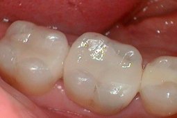 Composite Fillings