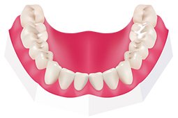 Pit and fissure sealants