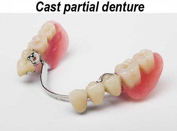 cast-partial-dentures