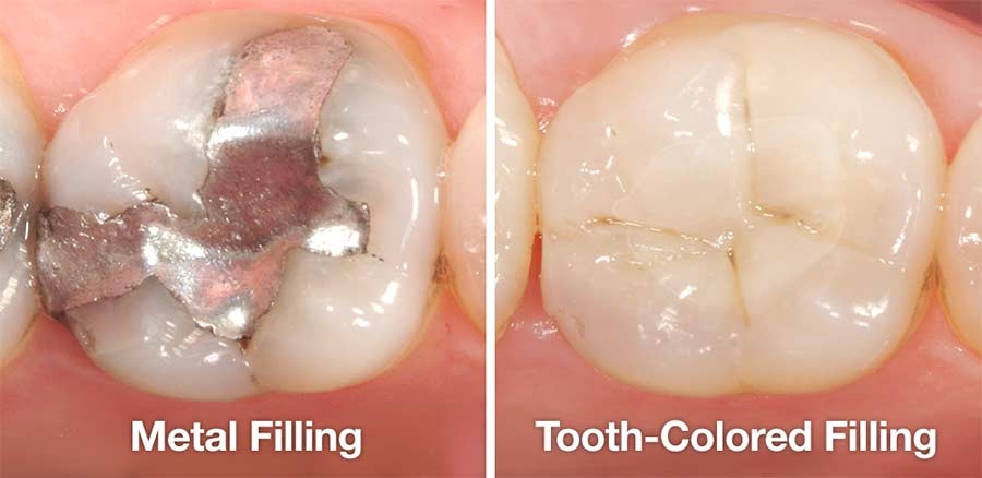 know-about-composite-fillings