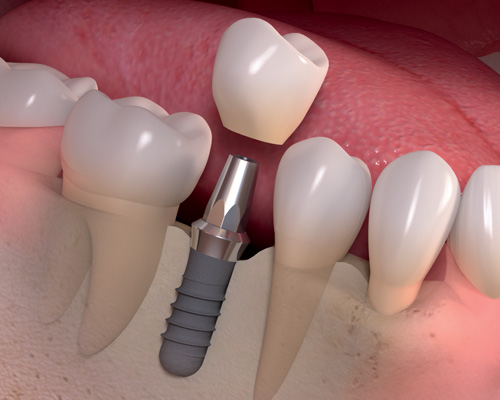 dental implant placement bangalore