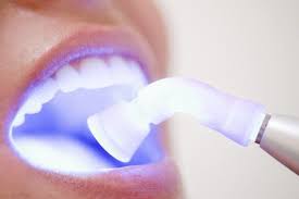 laser dentistry in bangalore, karnataka, india